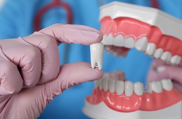 Benefits Of Dental Implants Compared With Traditional Dentures